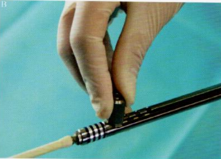 取石网篮为什么这么贵【ERCP护理】内镜下机械碎石取石术护理配合_https://www.jmylbn.com_新闻资讯_第15张