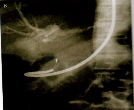 取石网篮为什么这么贵【ERCP护理】内镜下机械碎石取石术护理配合_https://www.jmylbn.com_新闻资讯_第20张