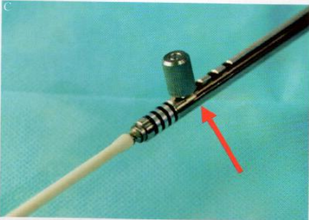 取石网篮为什么这么贵【ERCP护理】内镜下机械碎石取石术护理配合_https://www.jmylbn.com_新闻资讯_第16张