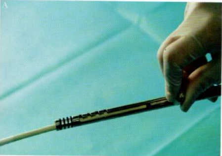 取石网篮为什么这么贵【ERCP护理】内镜下机械碎石取石术护理配合_https://www.jmylbn.com_新闻资讯_第14张