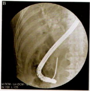取石网篮为什么这么贵【ERCP护理】内镜下机械碎石取石术护理配合_https://www.jmylbn.com_新闻资讯_第5张