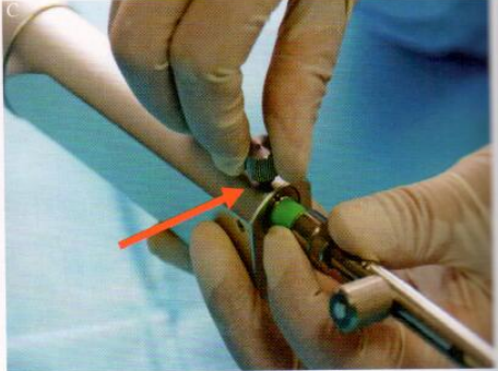 取石网篮为什么这么贵【ERCP护理】内镜下机械碎石取石术护理配合_https://www.jmylbn.com_新闻资讯_第12张