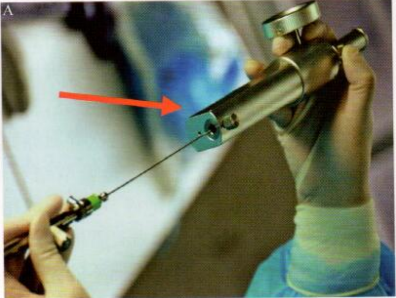 取石网篮为什么这么贵【ERCP护理】内镜下机械碎石取石术护理配合_https://www.jmylbn.com_新闻资讯_第10张