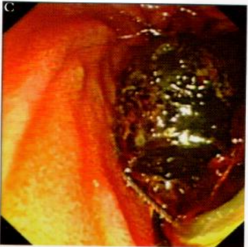 取石网篮为什么这么贵【ERCP护理】内镜下机械碎石取石术护理配合_https://www.jmylbn.com_新闻资讯_第6张