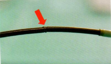 取石网篮为什么这么贵【ERCP护理】内镜下机械碎石取石术护理配合_https://www.jmylbn.com_新闻资讯_第18张