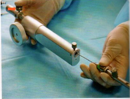 取石网篮为什么这么贵【ERCP护理】内镜下机械碎石取石术护理配合_https://www.jmylbn.com_新闻资讯_第11张