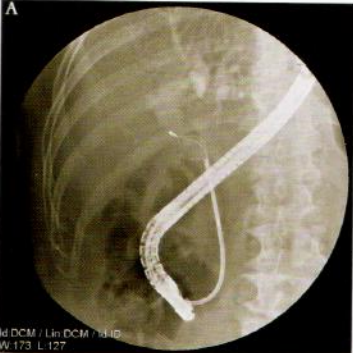 取石网篮为什么这么贵【ERCP护理】内镜下机械碎石取石术护理配合_https://www.jmylbn.com_新闻资讯_第4张