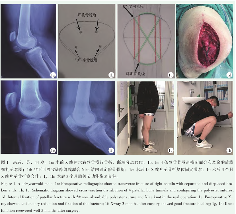 为什么用钢丝缝线骨科精读 ｜ 手术技巧：聚酯缝线Nice结固定横行髌骨骨折！_https://www.jmylbn.com_新闻资讯_第2张
