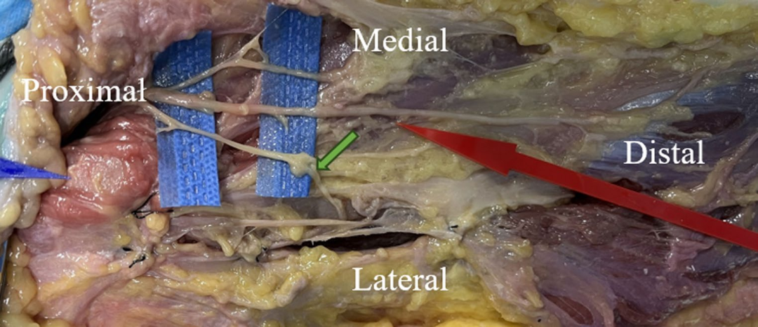 DAA全髋置换：关键解剖标志与操作要点