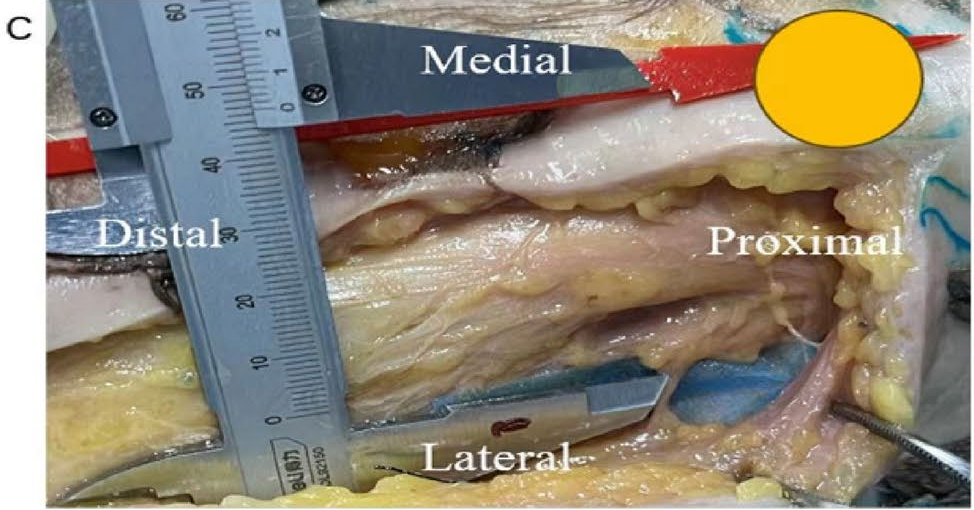DAA全髋置换：关键解剖标志与操作要点