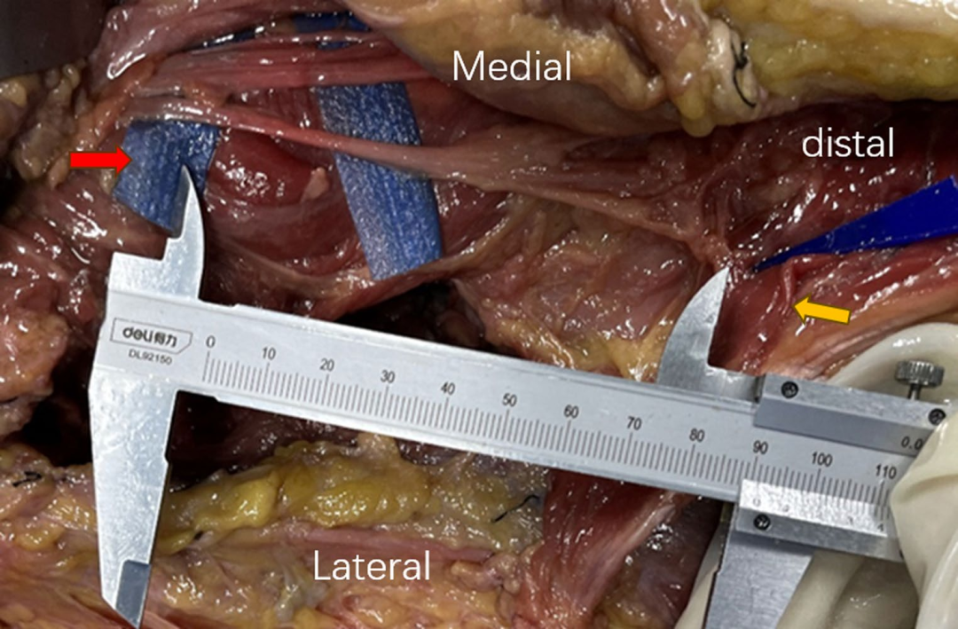 DAA全髋置换：关键解剖标志与操作要点