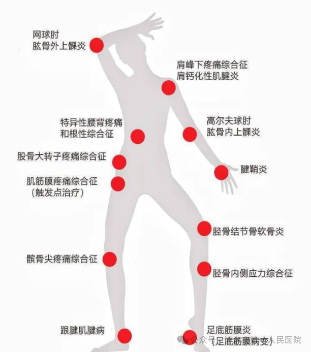 冲击波治疗效果怎么样【疼痛终结者】冲击波＋超声波疗法让止痛效果加倍_https://www.jmylbn.com_新闻资讯_第7张