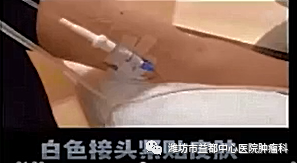 为什么要用泵打针便携式化疗泵的使用那些事儿_https://www.jmylbn.com_新闻资讯_第1张