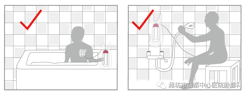 为什么要用泵打针便携式化疗泵的使用那些事儿_https://www.jmylbn.com_新闻资讯_第5张