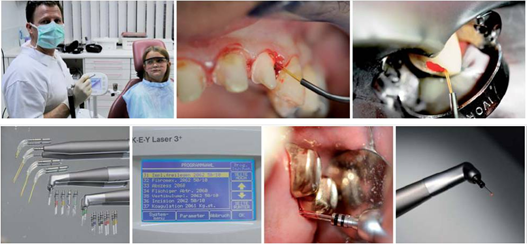 口腔激光有哪些牌子中国口腔激光市场的三重驱动与未来图景_https://www.jmylbn.com_新闻资讯_第5张