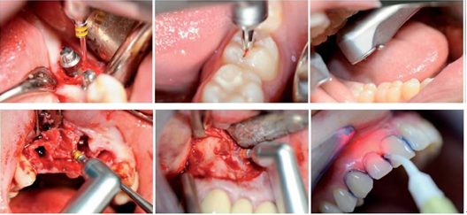 口腔激光有哪些牌子中国口腔激光市场的三重驱动与未来图景_https://www.jmylbn.com_新闻资讯_第4张