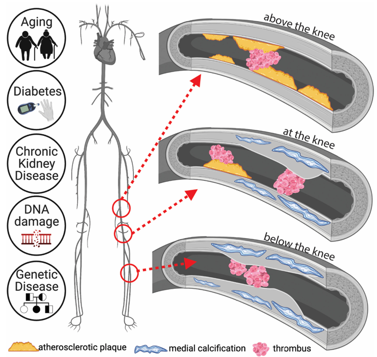 动脉钳怎么用动脉重度钙化导丝无法通过 针具技术超补救策略_https://www.jmylbn.com_新闻资讯_第5张