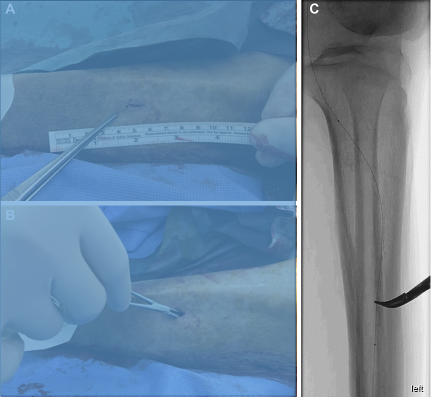动脉钳怎么用动脉重度钙化导丝无法通过 针具技术超补救策略_https://www.jmylbn.com_新闻资讯_第34张