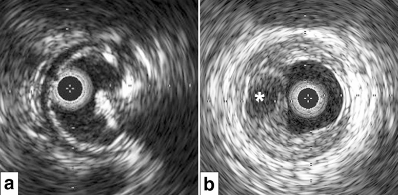 动脉钳怎么用动脉重度钙化导丝无法通过 针具技术超补救策略_https://www.jmylbn.com_新闻资讯_第15张