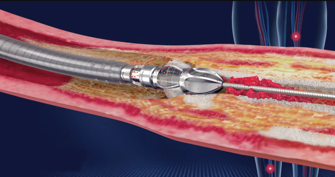 动脉钳怎么用动脉重度钙化导丝无法通过 针具技术超补救策略_https://www.jmylbn.com_新闻资讯_第38张