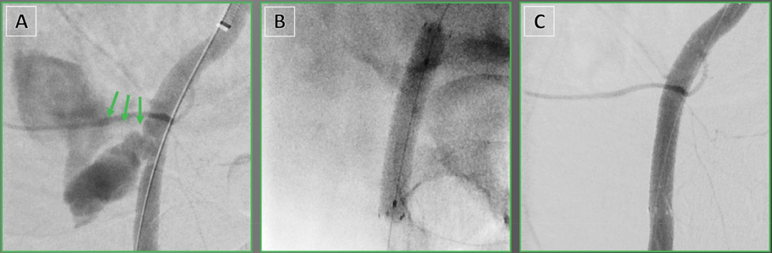 动脉钳怎么用动脉重度钙化导丝无法通过 针具技术超补救策略_https://www.jmylbn.com_新闻资讯_第24张