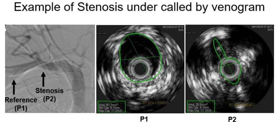 医学上ipc是什么米国静脉论坛上肢深静脉血栓临床指南与深度解析_https://www.jmylbn.com_新闻资讯_第17张