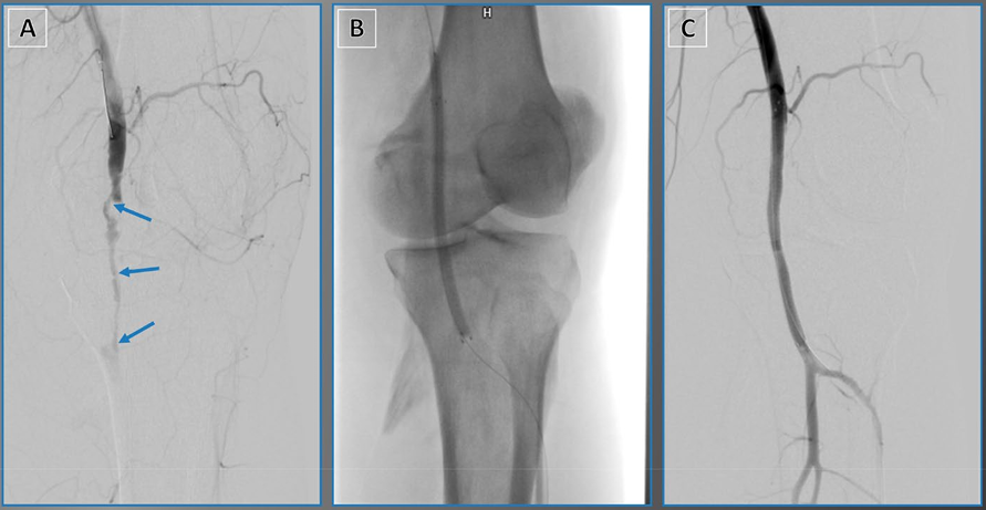 动脉钳怎么用动脉重度钙化导丝无法通过 针具技术超补救策略_https://www.jmylbn.com_新闻资讯_第25张