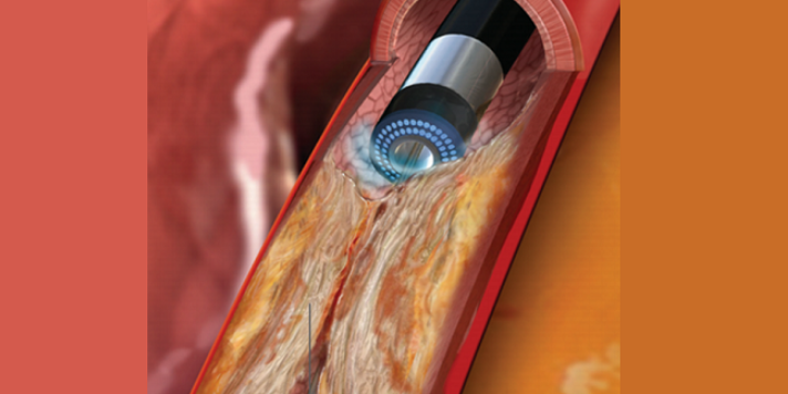 动脉钳怎么用动脉重度钙化导丝无法通过 针具技术超补救策略_https://www.jmylbn.com_新闻资讯_第37张
