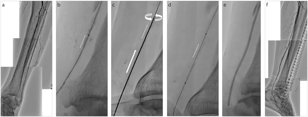 动脉钳怎么用动脉重度钙化导丝无法通过 针具技术超补救策略_https://www.jmylbn.com_新闻资讯_第19张