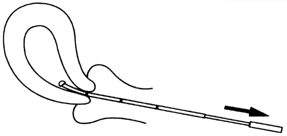 子宫内膜取样怎么取产品推荐｜子宫内膜细胞采集器_https://www.jmylbn.com_新闻资讯_第5张