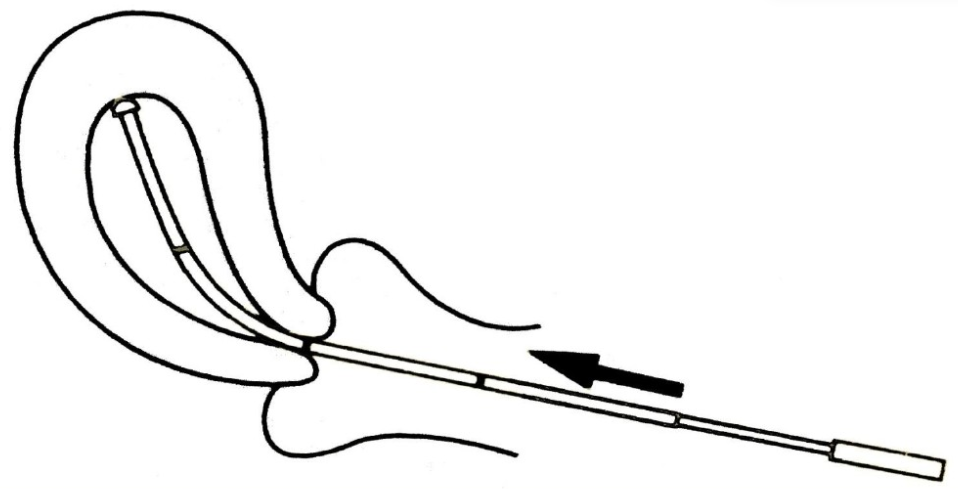 子宫内膜取样怎么取产品推荐｜子宫内膜细胞采集器_https://www.jmylbn.com_新闻资讯_第3张