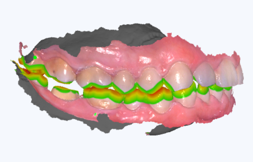 数字牙片机怎么用【新技术】口腔三维数字化扫描术_https://www.jmylbn.com_新闻资讯_第5张