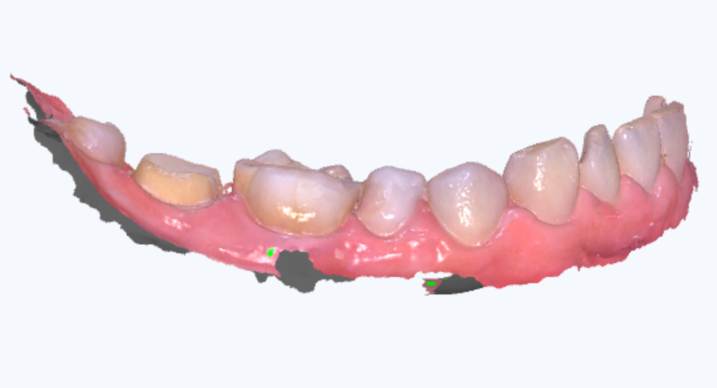 数字牙片机怎么用【新技术】口腔三维数字化扫描术_https://www.jmylbn.com_新闻资讯_第4张