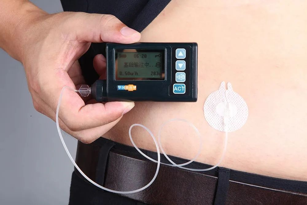 为什么要用泵打针糖尿病患者的“贴身守护神”——胰岛素泵治疗!_https://www.jmylbn.com_新闻资讯_第5张