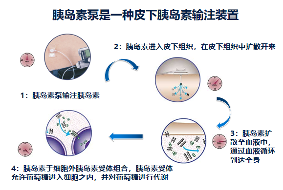 为什么要用泵打针糖尿病患者的“贴身守护神”——胰岛素泵治疗!_https://www.jmylbn.com_新闻资讯_第9张