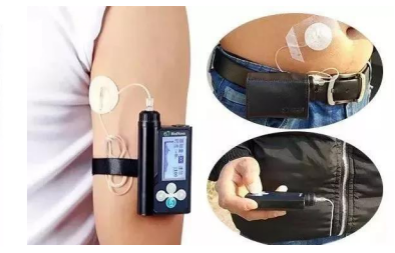 为什么要用泵打针糖尿病患者的“贴身守护神”——胰岛素泵治疗!_https://www.jmylbn.com_新闻资讯_第14张