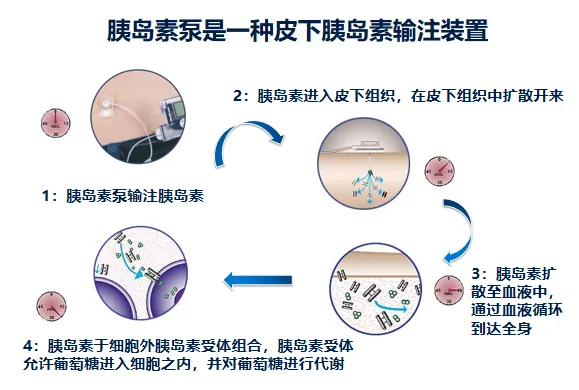 为什么要用泵打针智能控糖先锋——胰岛素泵，助您精准控糖无忧！_https://www.jmylbn.com_新闻资讯_第14张