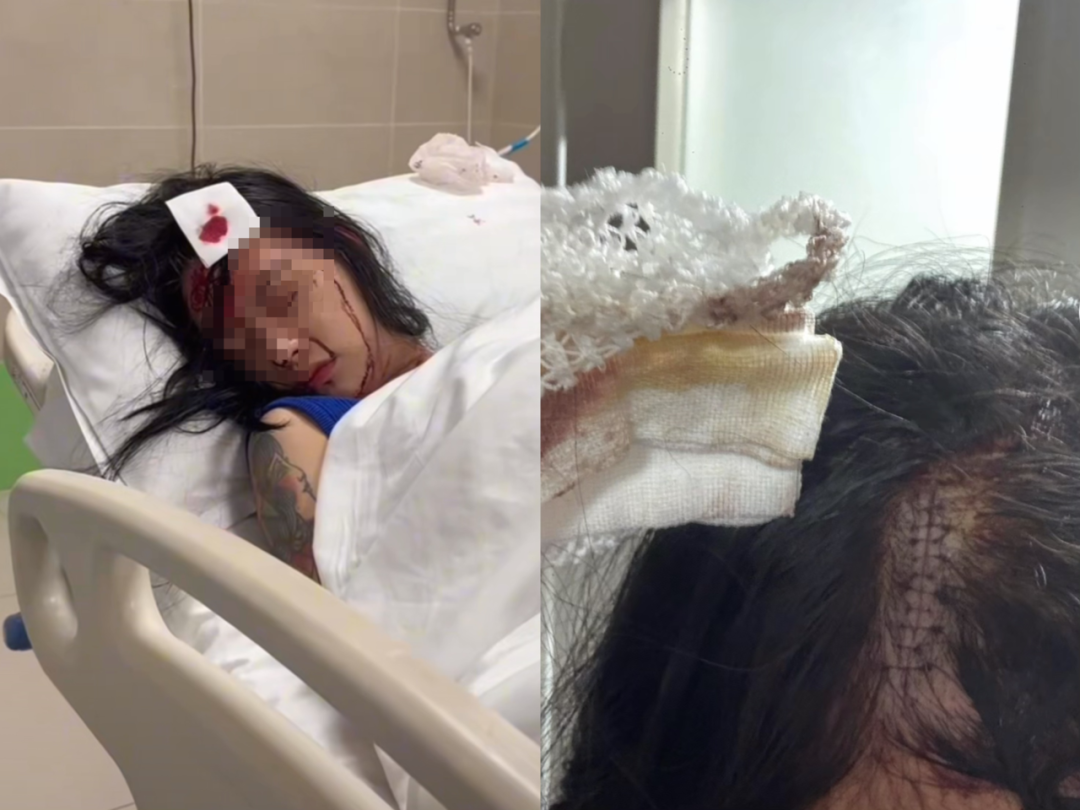 砍伤闺蜜头欲2万和解,女子被闺蜜酒后用菜刀砍伤头部，伤口5厘米缝十余针！闺蜜被行政..