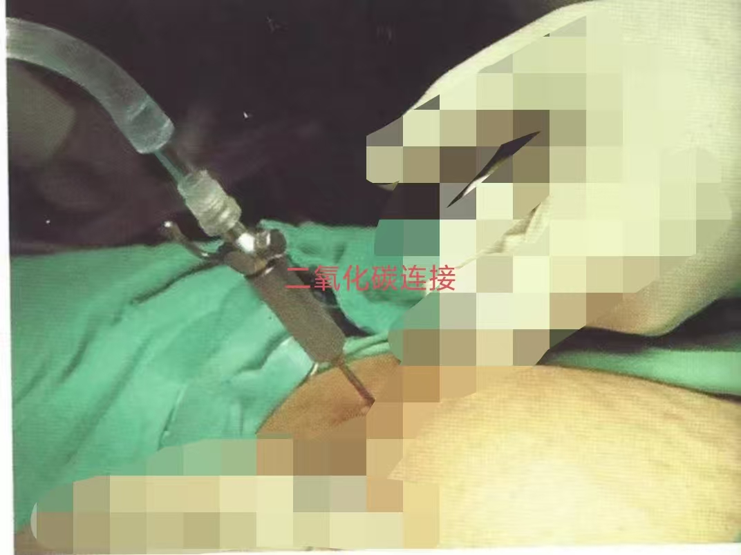 气腹机怎么吸气的【杏林科普】腹腔镜手术的“小小助手”：二氧化碳气腹_https://www.jmylbn.com_新闻资讯_第4张