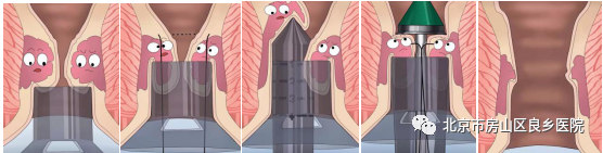 pph吻合器怎么使用普外科“痔”微创治疗系列科普（三）吻合器痔上黏膜环切术（PPH）_https://www.jmylbn.com_新闻资讯_第5张