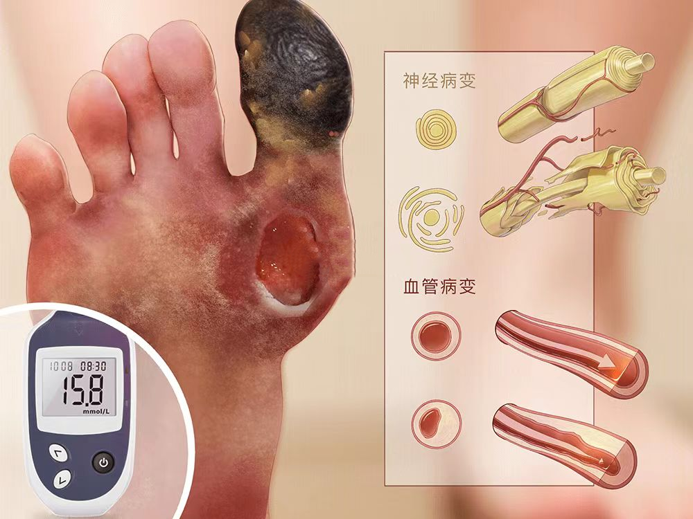 为什么糖尿病不能震动【广大糖友的福音！】糖尿病周围神经病变筛查之震动感觉阈值检测_https://www.jmylbn.com_新闻资讯_第6张