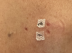 激光和电刀区别是什么中关村医院顺利召开色素痣诊治与康复临床研究分享会_https://www.jmylbn.com_新闻资讯_第11张