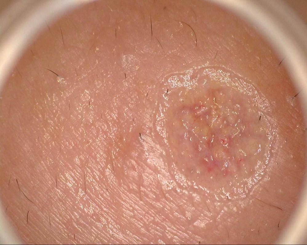 激光和电刀区别是什么中关村医院顺利召开色素痣诊治与康复临床研究分享会_https://www.jmylbn.com_新闻资讯_第13张