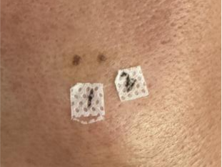 激光和电刀区别是什么中关村医院顺利召开色素痣诊治与康复临床研究分享会_https://www.jmylbn.com_新闻资讯_第10张