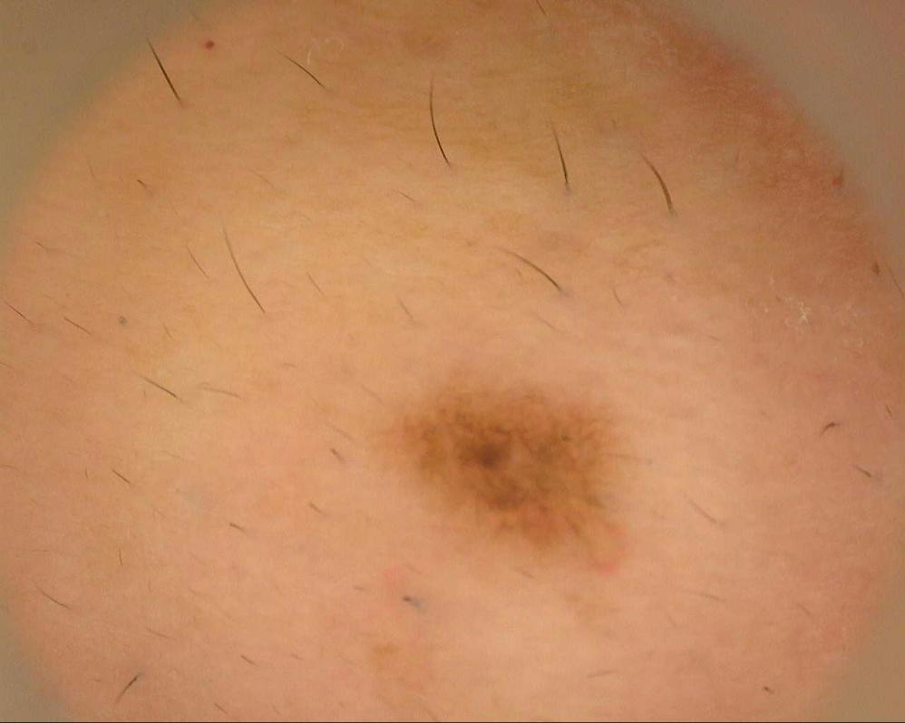 激光和电刀区别是什么中关村医院顺利召开色素痣诊治与康复临床研究分享会_https://www.jmylbn.com_新闻资讯_第12张