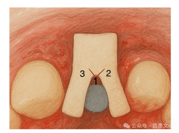 “裤子技术”：种植体围手术期软组织增大术的新方法