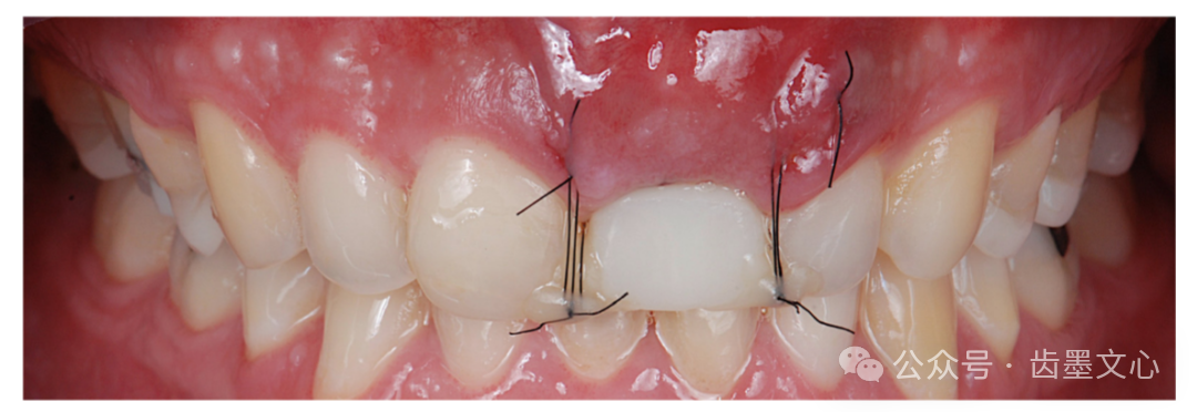 “裤子技术”：种植体围手术期软组织增大术的新方法