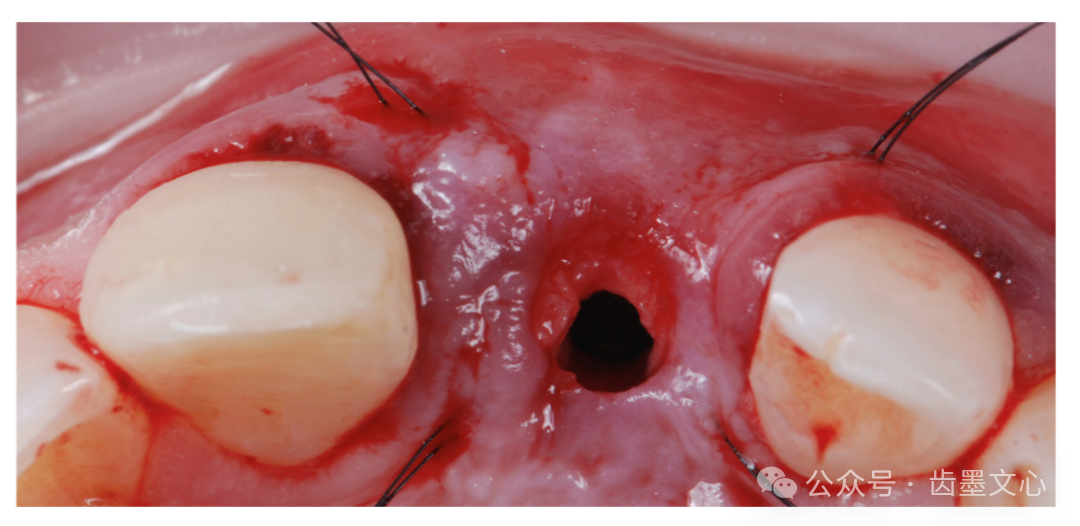 “裤子技术”：种植体围手术期软组织增大术的新方法