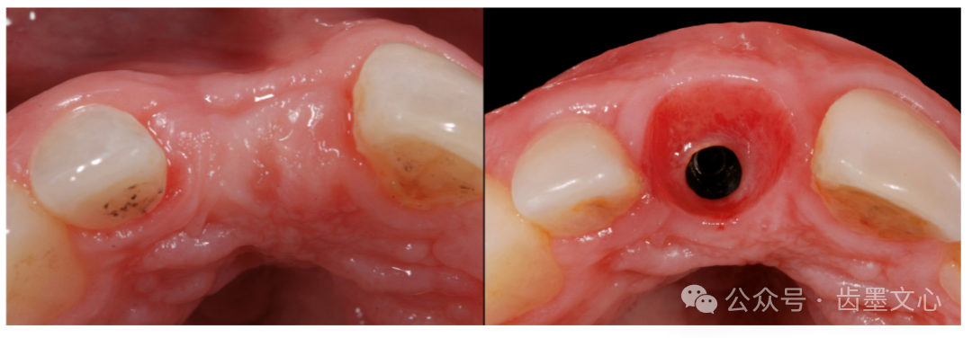 “裤子技术”：种植体围手术期软组织增大术的新方法
