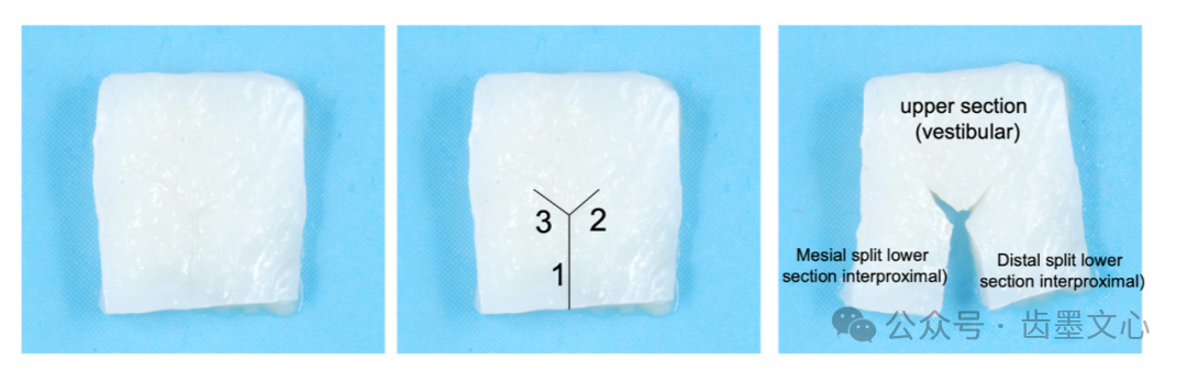 “裤子技术”：种植体围手术期软组织增大术的新方法